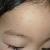 孩子出水痘的症状是什么
