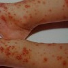 典型水痘有哪些症状
