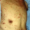 水痘的症状有哪些