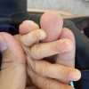 得了湿疹要怎么护理
