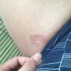 男性梅毒什么原因引起的