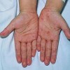 梅毒患者的护理工作要怎样做