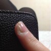 甲沟炎拔甲后怎样护理