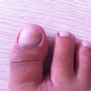 甲沟炎患者的护理方式有哪些