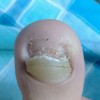 甲沟炎护理常识有什么