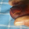 甲沟炎患者如何科学护理