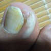 甲沟炎你必须要知道的护理措施
