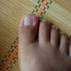 应该怎么预防甲沟炎