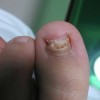 甲沟炎患者的护理方法有哪些