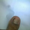 甲沟炎的护理方式有哪些