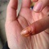 甲沟炎的手术后护理
