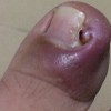 甲沟炎的日常护理怎么做