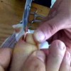 甲沟炎要怎样预防