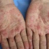 山东性病淋巴肉芽肿如何进行护理