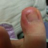 明了甲沟炎该如何预防
