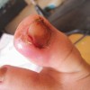 儿童预防甲沟炎需做哪些事项