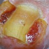 预防甲沟炎的方法