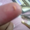 甲沟炎的预防措施