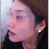 太田痣的形成原因是什么