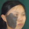 太田痣久治不愈的原因
