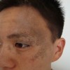 太田痣形成的原因有哪些
