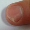 哪些原因会导致灰指甲呢