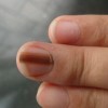 灰指甲患者的发病原因