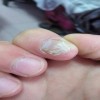 灰指甲常见发病原因