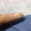 得了灰指甲后会有哪些症状？