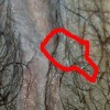尖锐湿疣生活中怎么预防