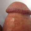 尖锐湿疣老是复发的原因是什么