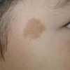 咖啡斑的形成原因