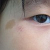咖啡斑的症状及原因介绍