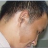 咖啡斑发生的原因及偏方分析