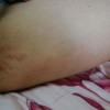 毛发糠疹有哪些症状