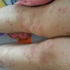 儿童萎缩性毛发苔藓的症状表现