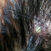 毛囊炎患者要如何护理