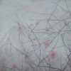 怎样做好毛囊炎的护理工作呢