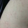 毛囊角化病图片