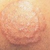 如何护理体癣患者