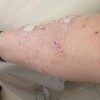 体癣怎么预防护理