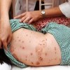 什么是水痘的发病原理