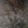秃发性毛囊炎的症状以及防治