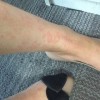 玫瑰糠疹患者如何健康饮食呢