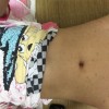 玫瑰糠疹患者的饮食上要注意什么