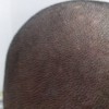 秀发性毛囊炎的症状是什么
