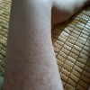 玫瑰糠疹在饮食上有哪些需要注意的