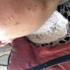 玫瑰糠疹发病原因有哪些呢