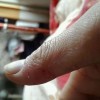 诱发玫瑰糠疹原因