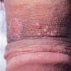生殖器疱疹引发的并发症有哪些
